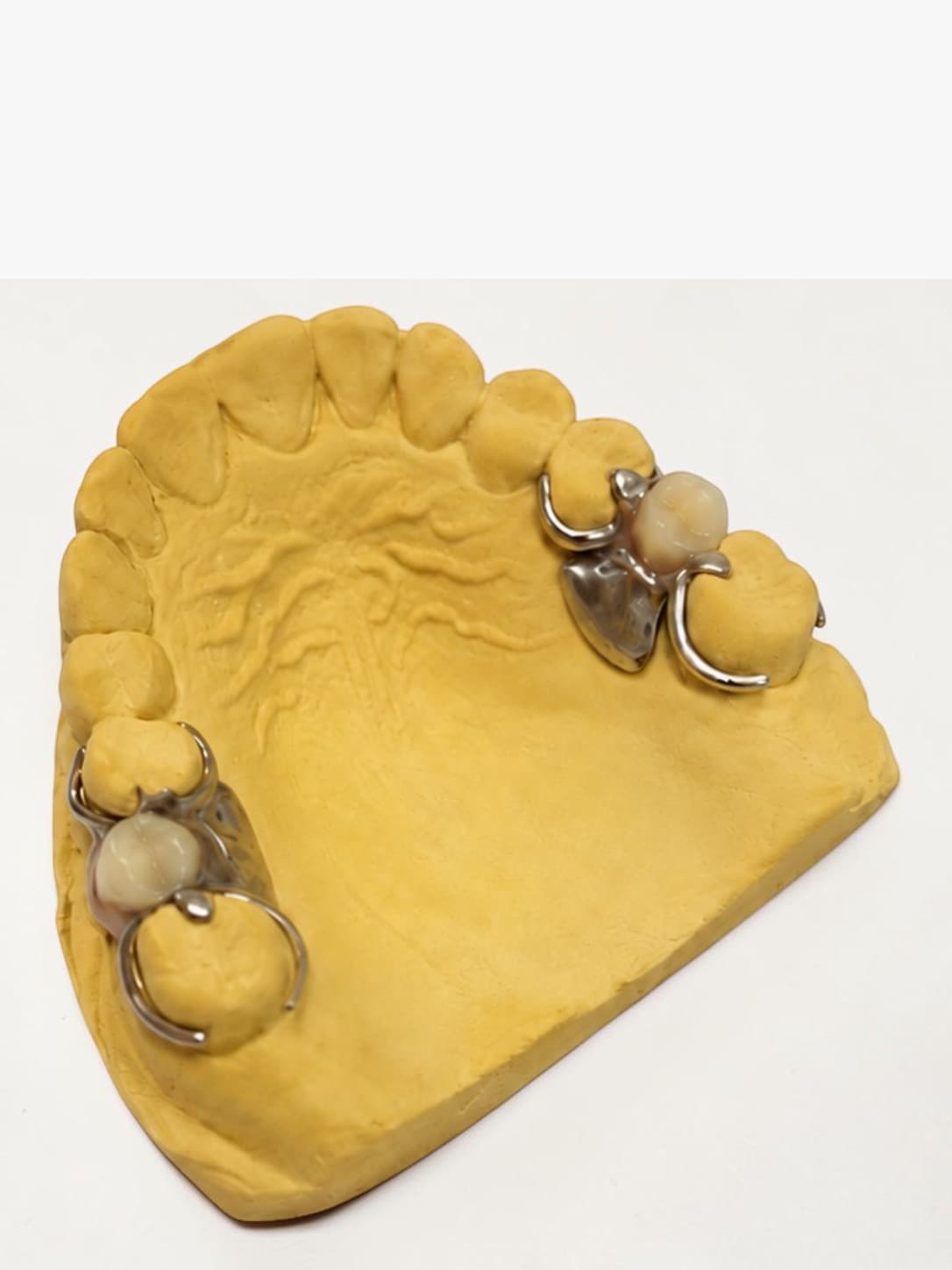 Modelo superior con protesis parcial metalica